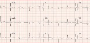 electrocardiograma normal