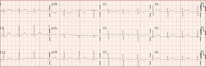 electrocardiograma normal